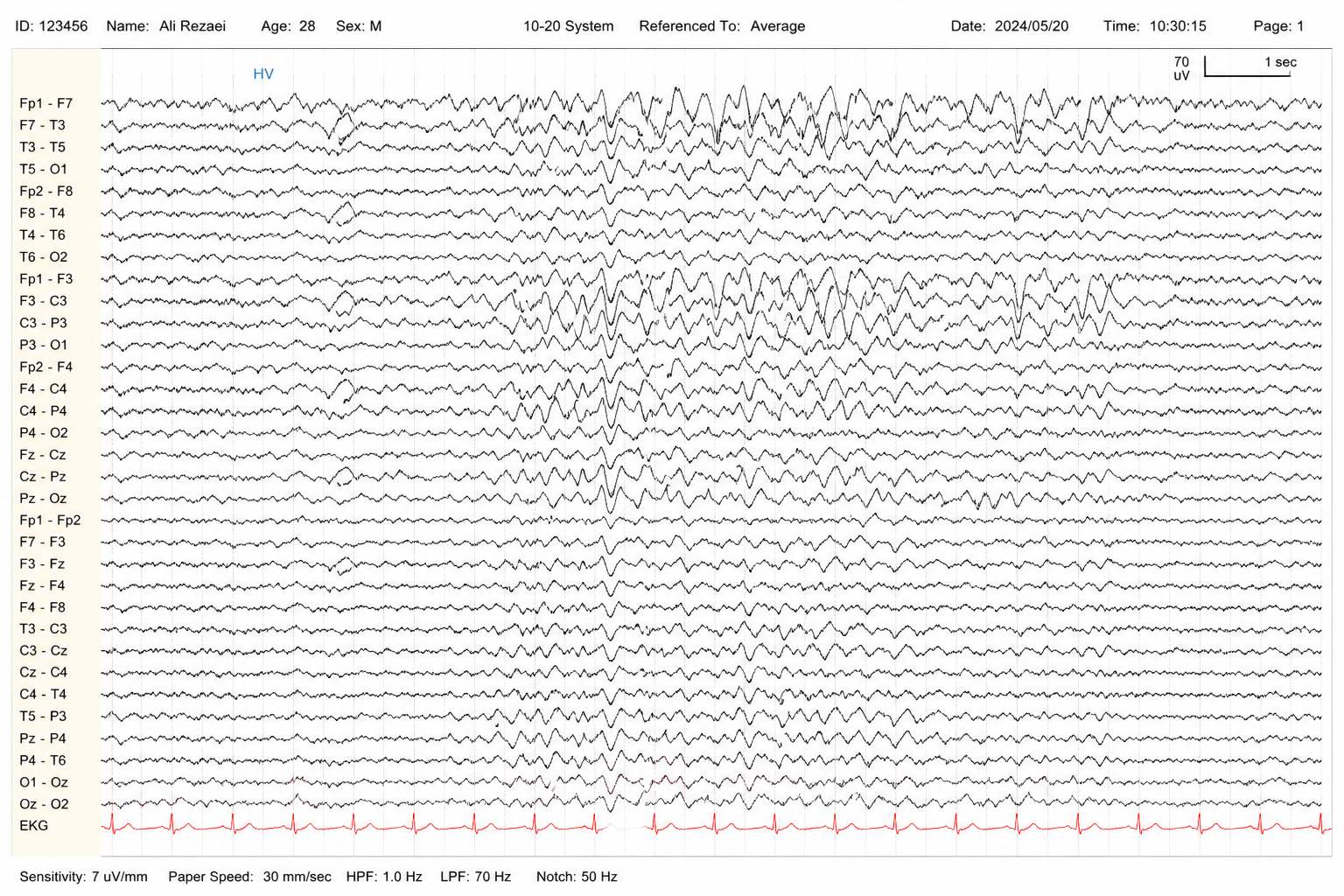 تفاوت EEG و QEEG چیست؟